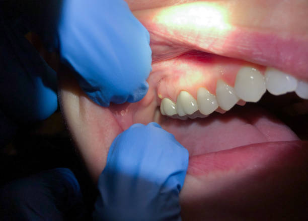 Best Emergency Treatment for Dental Infections or Abscesses in East Peoria, IL