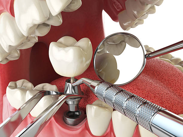 Best Emergency Dental Care for Broken or Chipped Teeth in East Peoria, IL